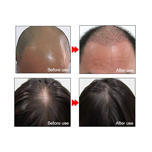 Autobestown 20 ml Saç Büyüme uçucu yağ Doğal Anti Saç Dökülmesi Daha Hızlı Daha Fazla Saç Çıkma Saç Onarım Tedavisi Saç Bakım